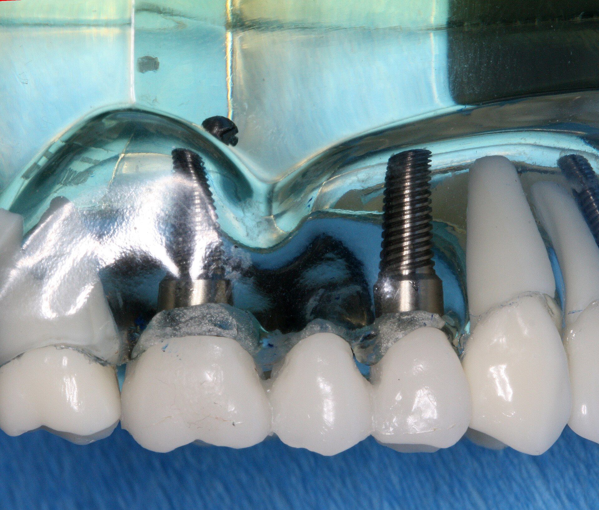 Maqueta de una dentadura con dos implantes y piezas blancas sobre fondo azul.